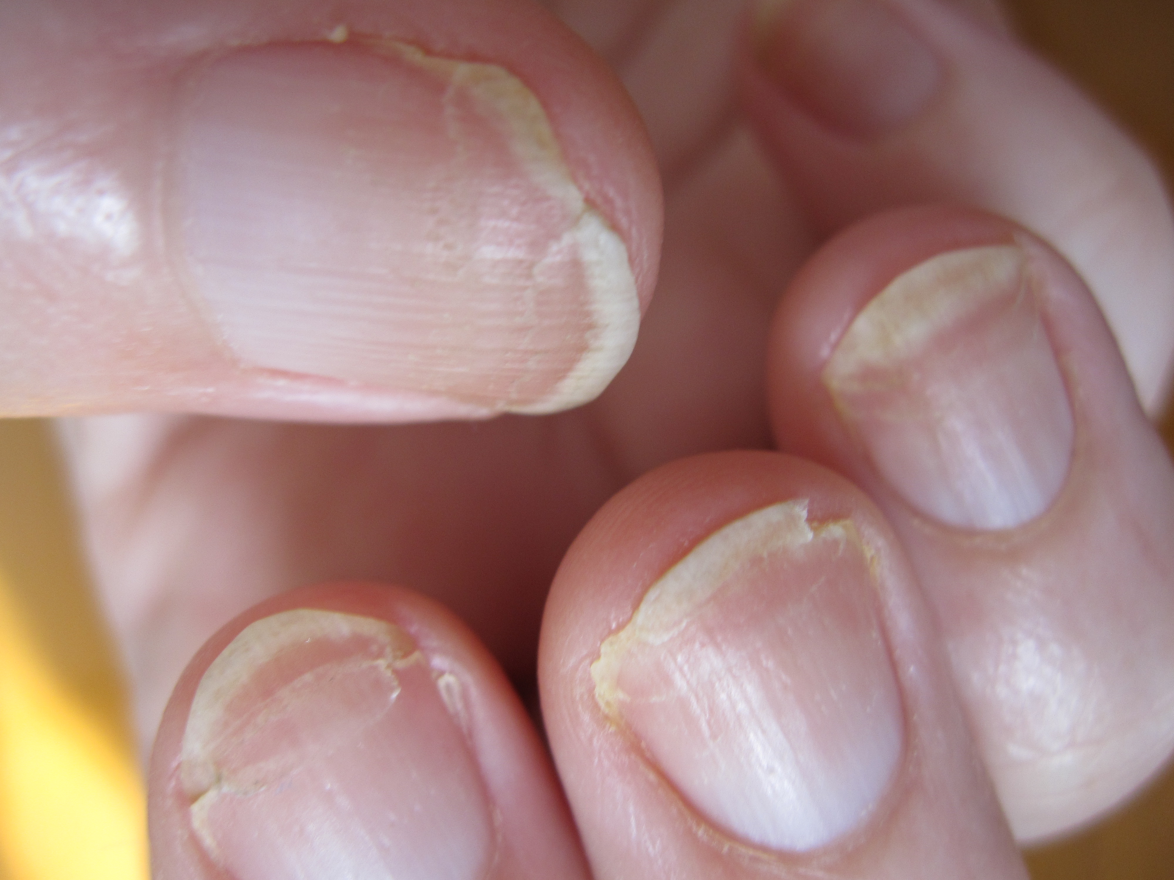 Splitting Fingernails: Causes, & Treatment